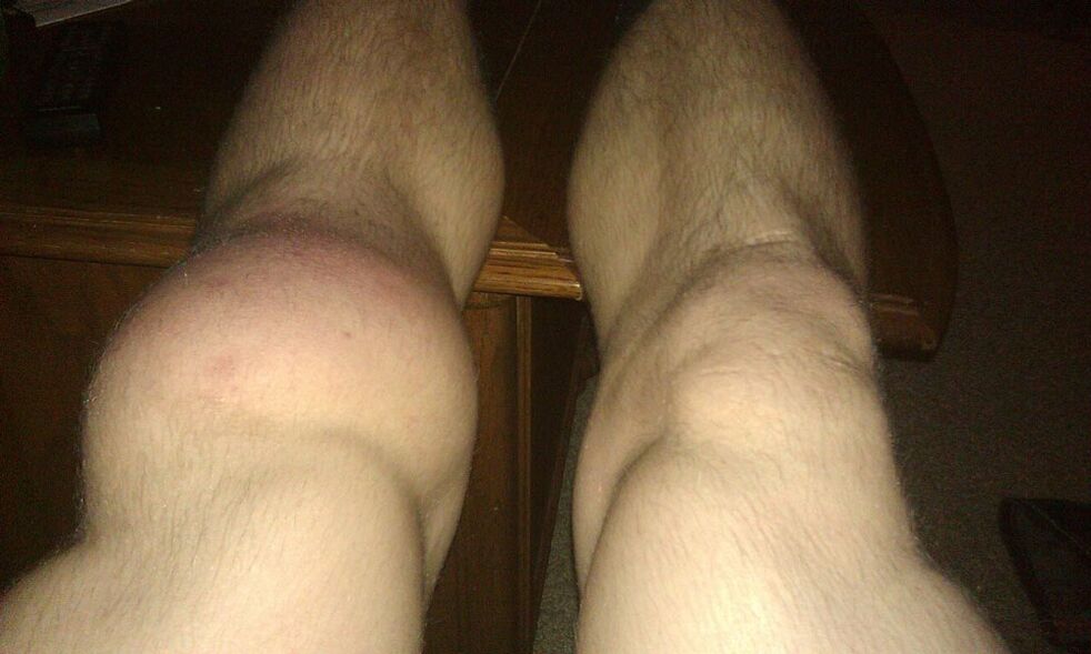 Knie vor der Behandlung mit Osteflex