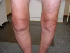 Symptome einer Arthrose des Kniegelenks