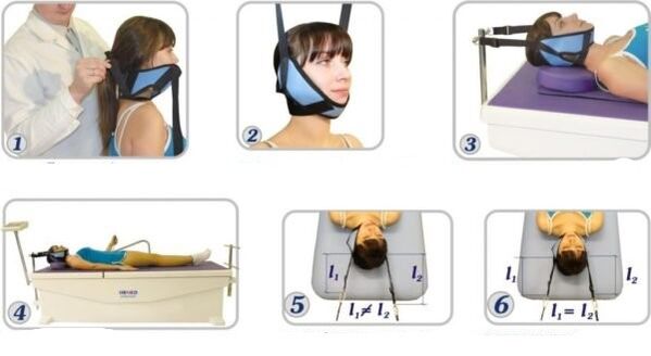 Cervical Osteochondrosis Behandlung mit Eliminierung