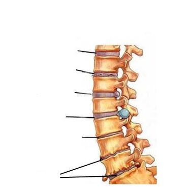 Osteochondrose -Entwicklungsphasen