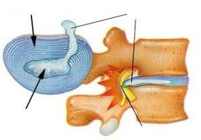 Zerstörung des faserigen Rings mit zervikaler Osteochondrose