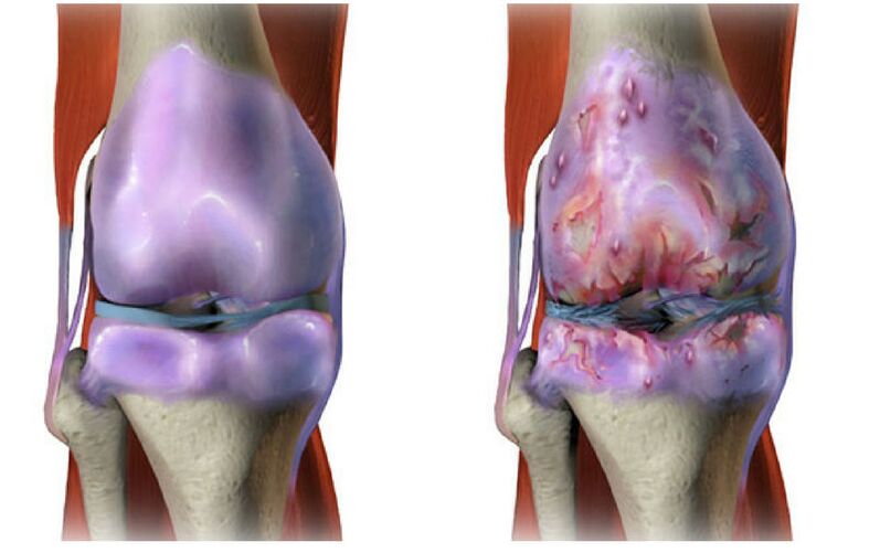 gesunder Knorpel und Zerstörung des Kniegelenks bei Arthrose