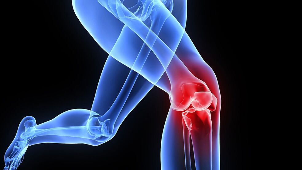 Knieprobleme aufgrund von Arthrose.